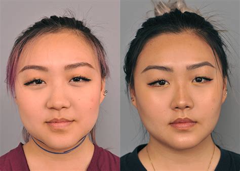 Buccal Fat Reduction .